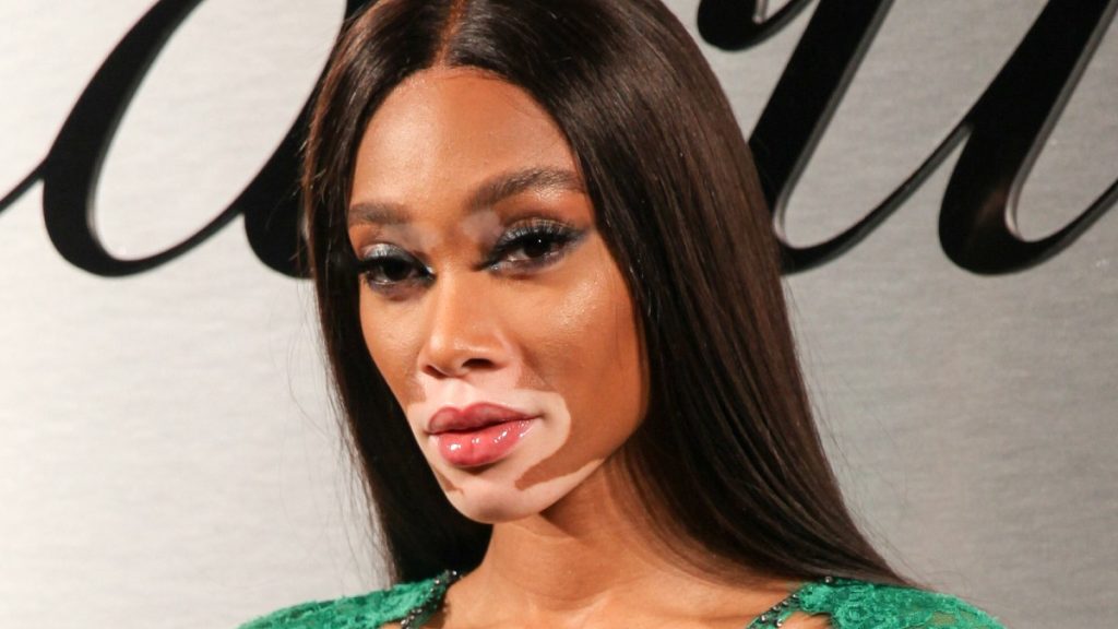 ¡Día Mundial de Vitiligo! Una enfermedad que afecta al 2% de la población