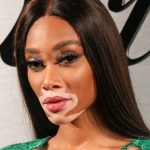 ¡Día Mundial de Vitiligo! Una enfermedad que afecta al 2% de la población