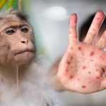 Kenia registra primer caso de virus de mpox, antes conocido como viruela del mono