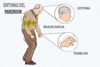 El sonido de la voz ayuda a diagnosticar el Parkinson